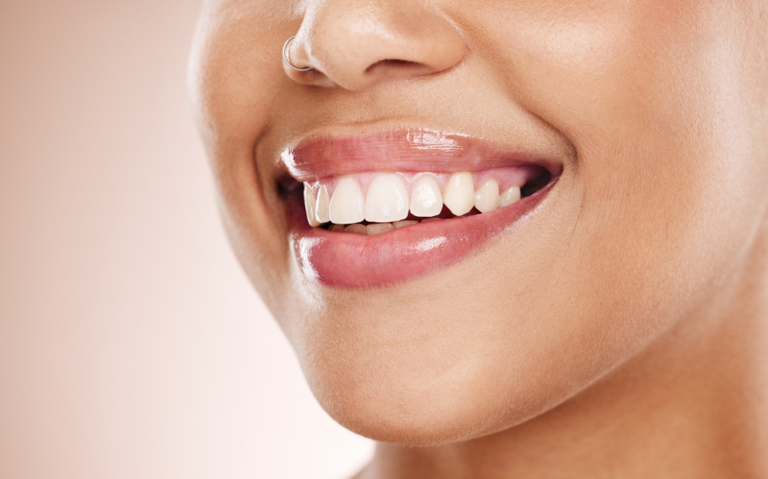 How Long After Teeth Whitening Can I Drink Red Wine