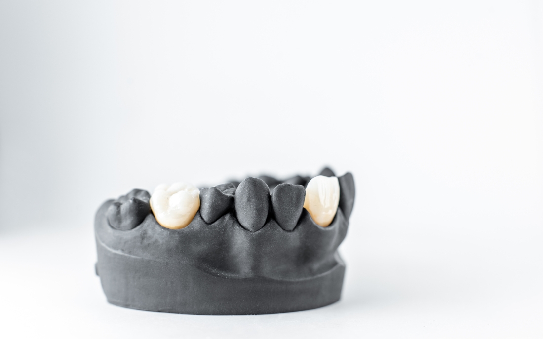 Addressing The Issue Of Sensitivity After Crown Placement