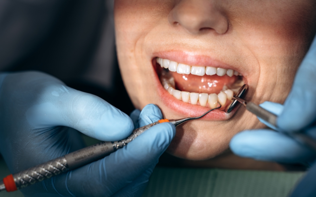 Preventing Cavities Tips for Maintaining Healthy Teeth