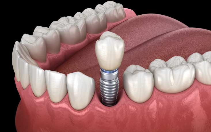 How To Maintain Your Dental Implants For Longevity