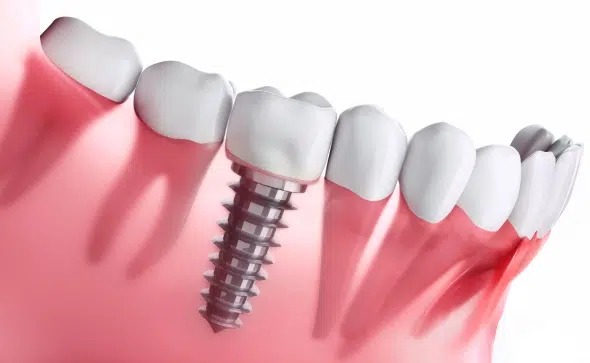 Dental Implants Easley Sc - Cove Dental Care