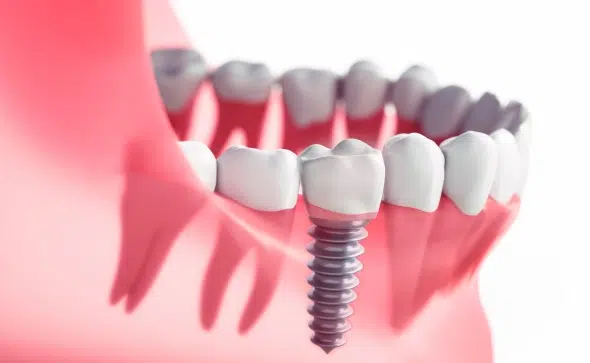 Dental Implants Greer Sc - Cove Dental Care