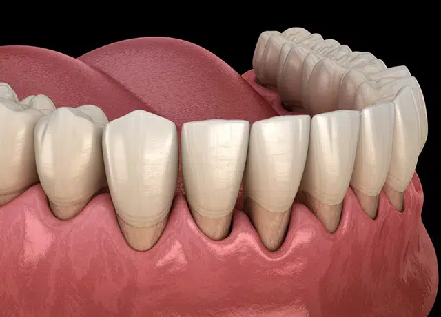 Periodontal Disease Treatment Greer Sc - Cove Dental Care