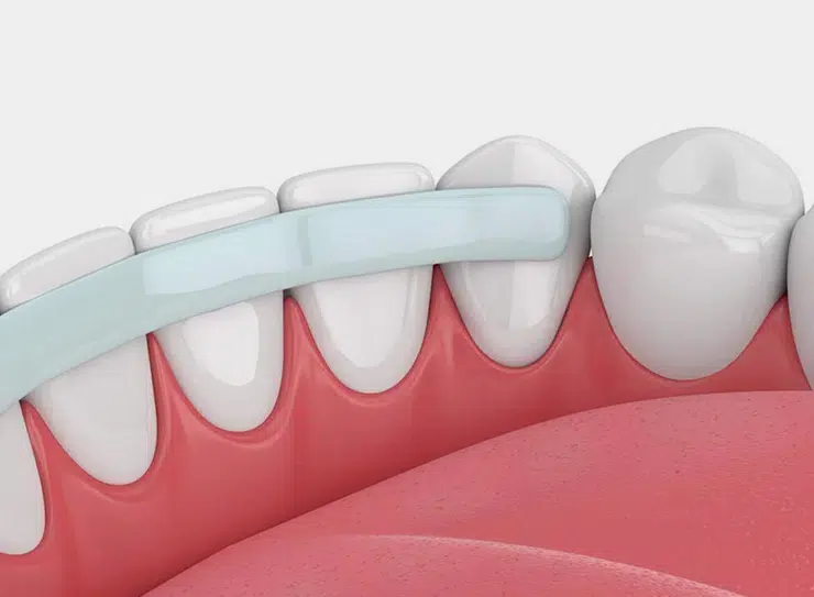 Teeth Bonding Greer Sc - Cove Dental Care Greer