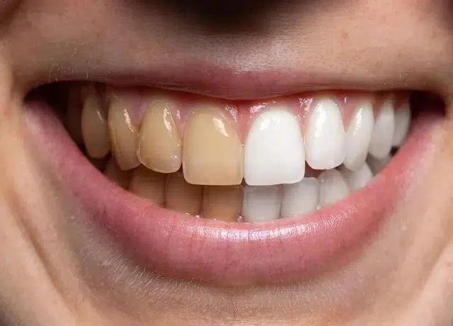 Teeth Whitening Easley Sc - Cove Dental Care