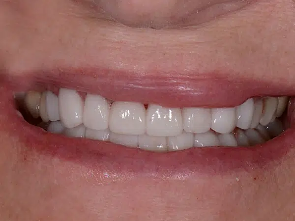 After treatment