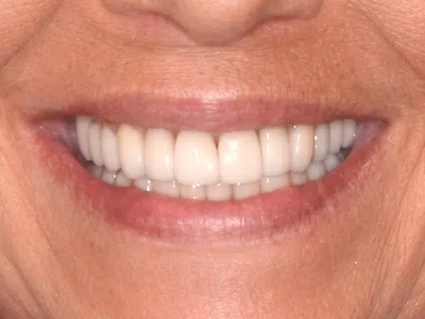 After treatment