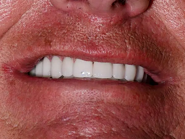 After treatment