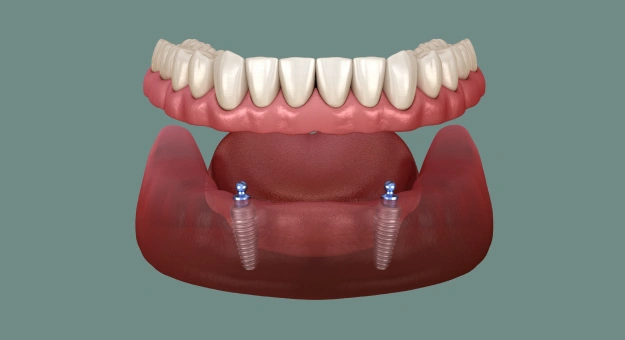 Snap-On Dentures