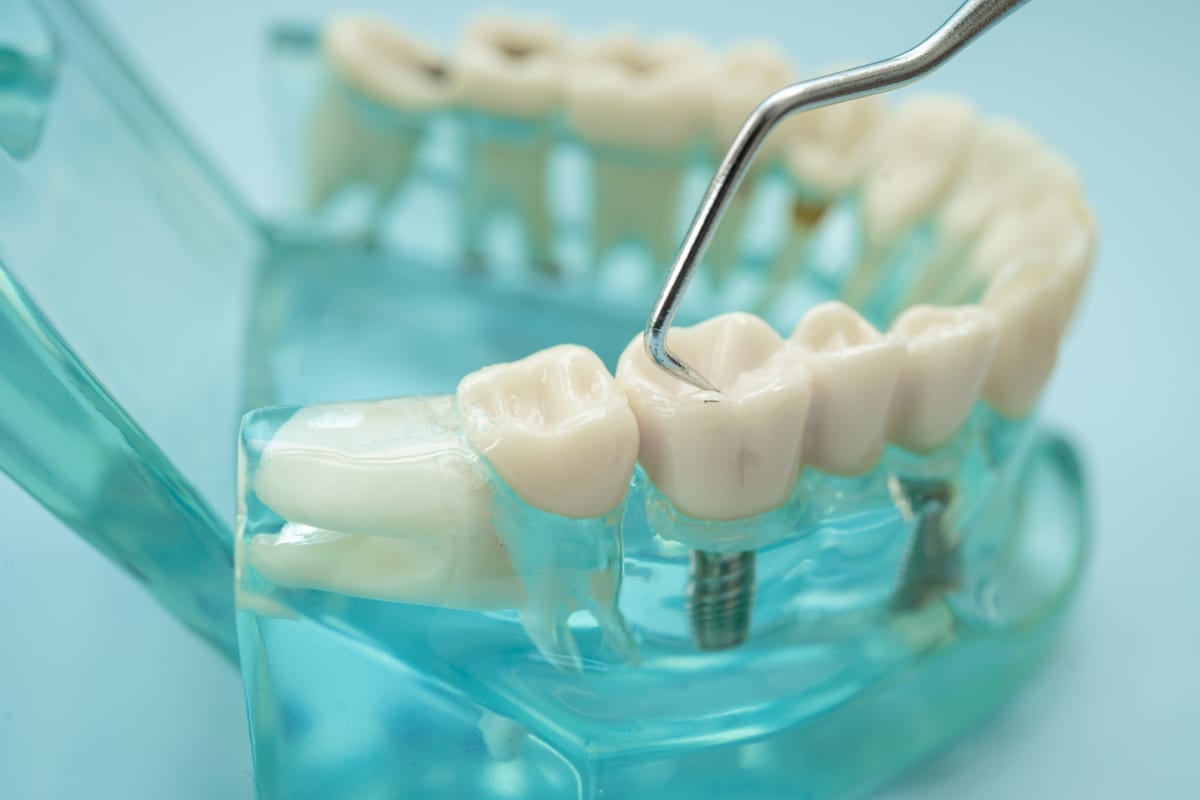 Restorative Dentistry in Easley